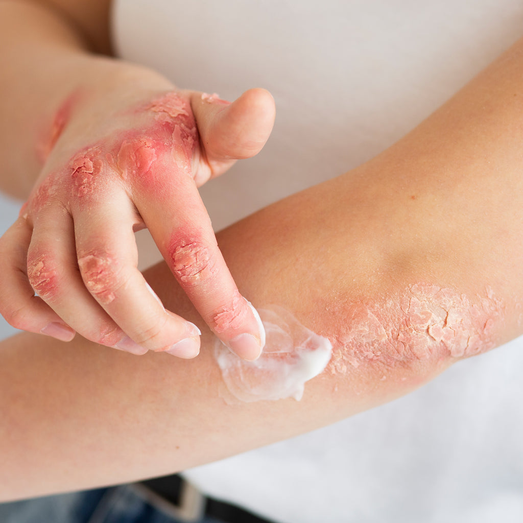 7 wskazówek dotyczących pielęgnacji skóry przy łuszczycy!